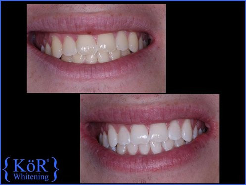 KOR Whitening example