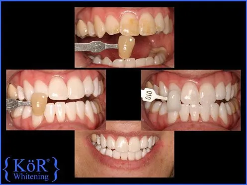 KOR Whitening Example
