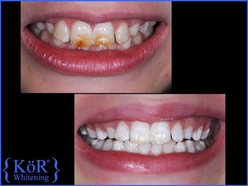 KOR Whitening example