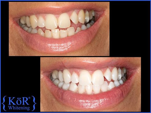 KOR Whitening example