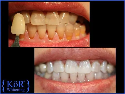 KOR Whitening example