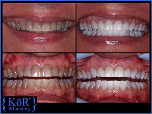 KOR Whitening example