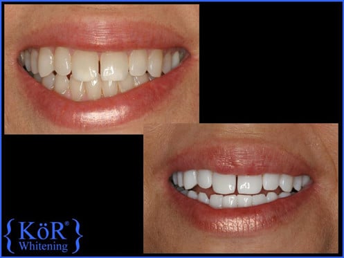 KOR Whitening example