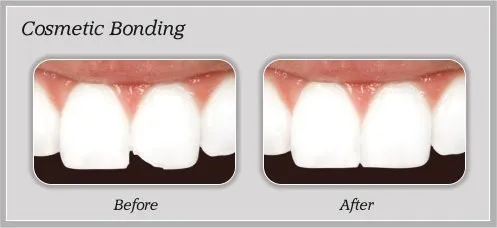 Cosmetic Bonding