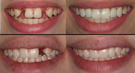 Implant Before & After